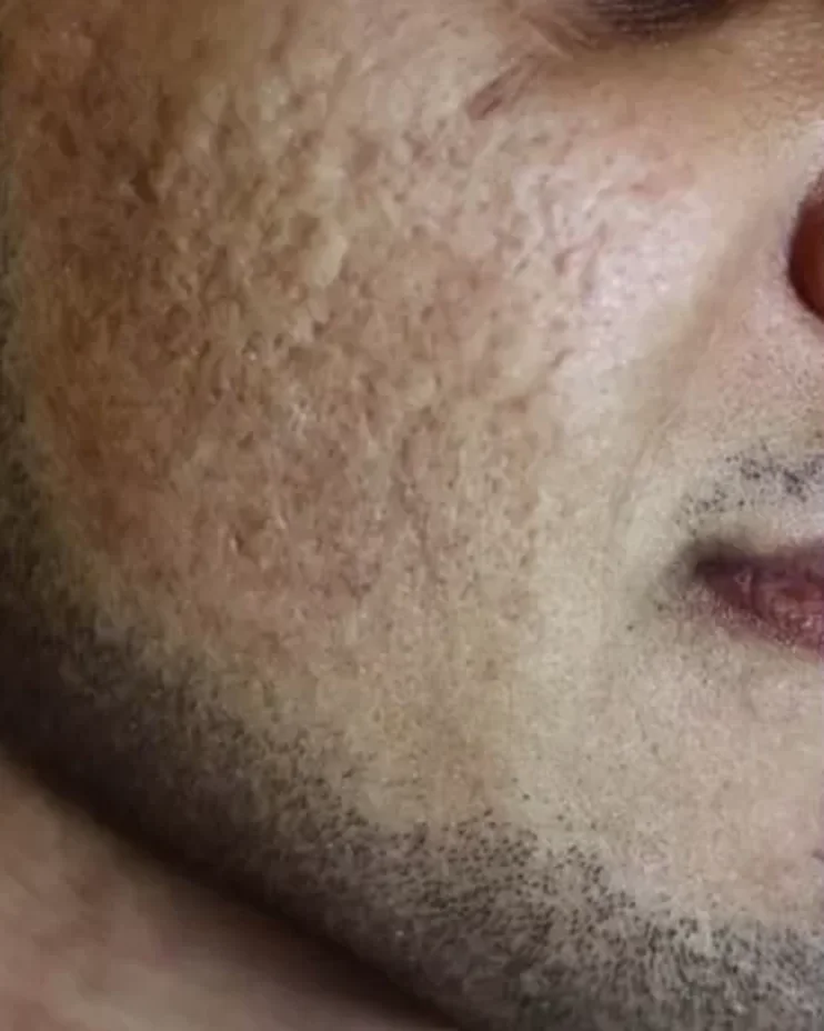 Before treatment